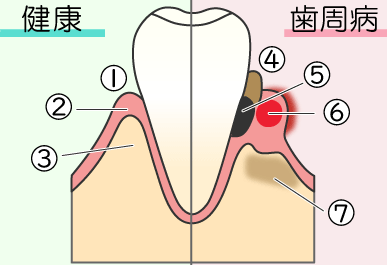 健康な状態と歯周病の状態の図