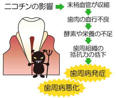 図解：ニコチンが歯周病に及ぼす影響