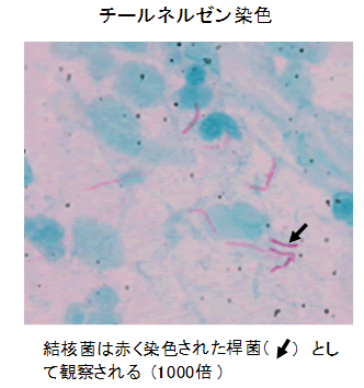 図-2 抗酸菌染色の顕微鏡写真　チールネルゼン染色　結核菌は赤く染色された桿菌として観察される（1000倍）
