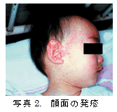 写真2.　顔面の発疹