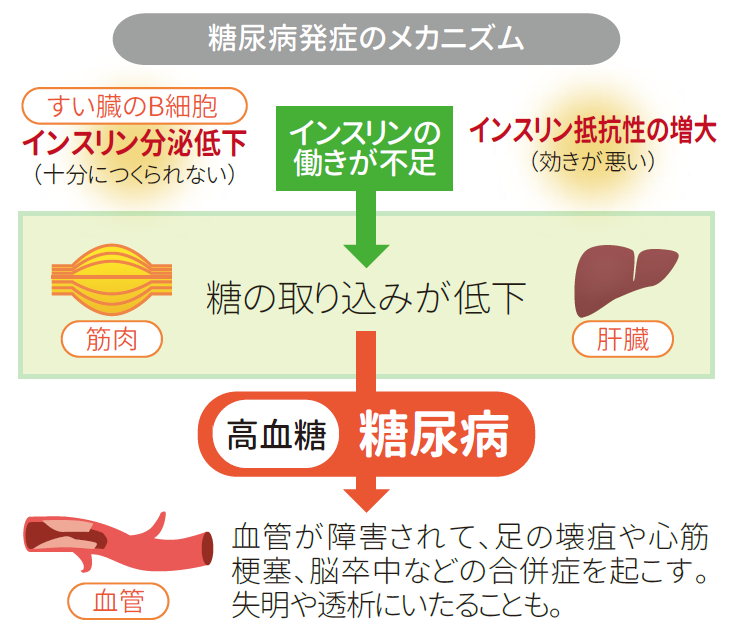 糖尿病のメカニズム