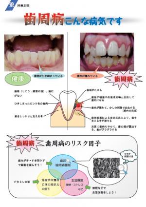 歯周病こんな病気ですパネル