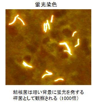 図-2 抗酸菌染色の顕微鏡写真　蛍光染色　結核菌は暗い背景に蛍光を発する桿菌として観察される（1000倍）